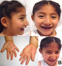 angelman syndrome